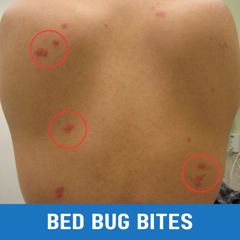 How to Prevent Bed Bug Bites While Sleeping A Step by Step Guide